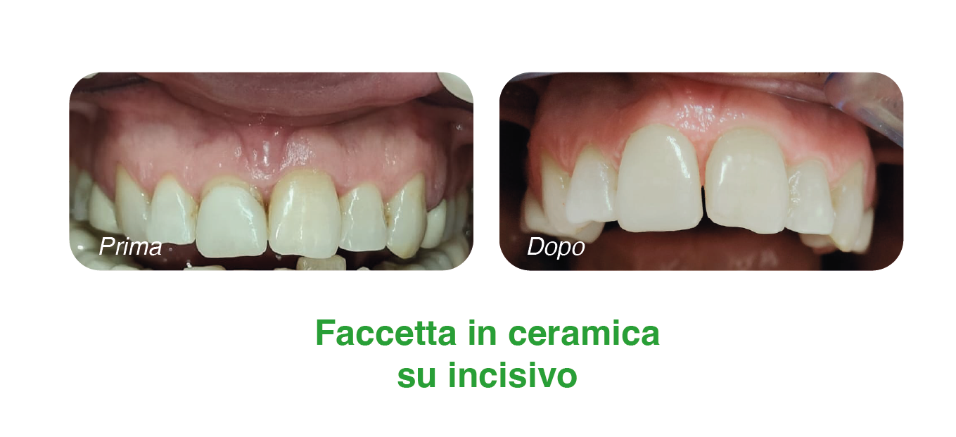 facc-2
