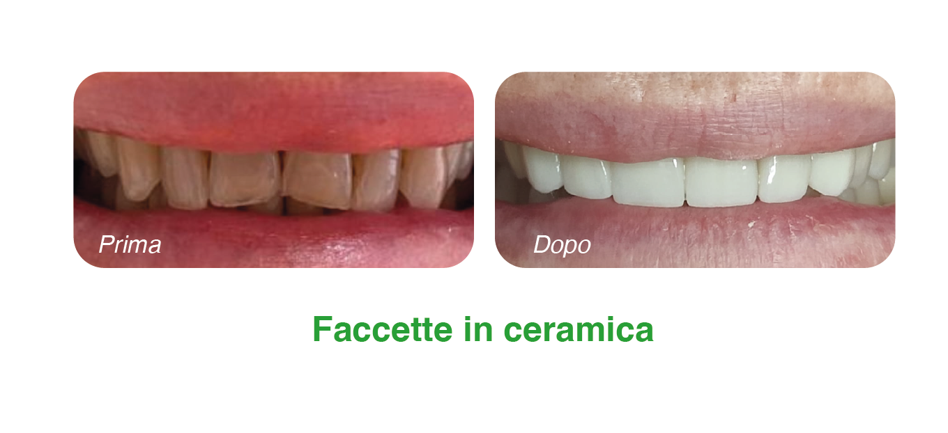 faccette